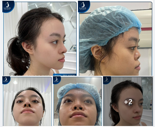 10 ngày hoàn thiện dáng mũi mới cho em gái bị tật mũi bẩm sinh