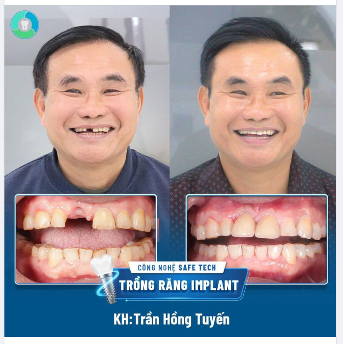 KHÔI PHỤC RĂNG CỬA VỚI CÔNG NGHỆ DCT - THẨM MỸ TỐI ƯU