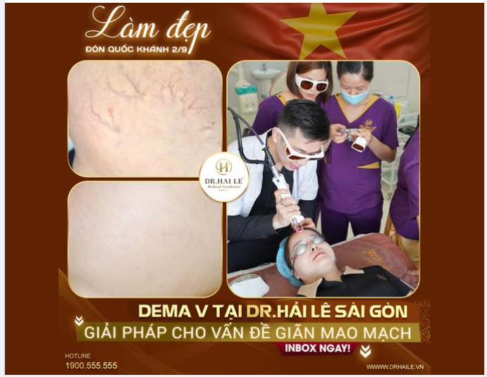  Giãn mao mạch là hiện tượng trên bề mặt da nổi lên các mạch máu li ti.