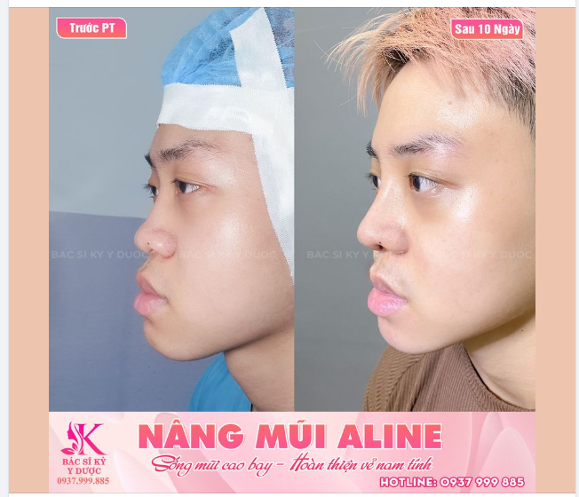 SỐNG MŨI CAO BAY - HOÀN THIỆN VẺ NAM TÍNH