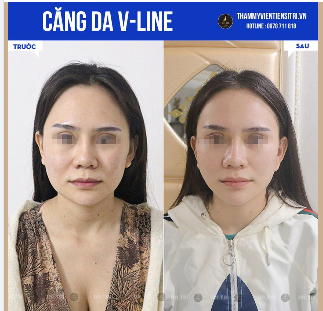 CÂN CHỈNH GƯƠNG MẶT - NHỜ CĂNG DA V-LINE
