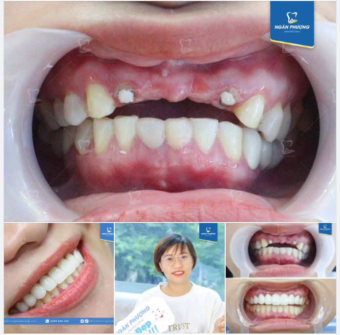Thảo Khuyên do không may mà mất khá nhiều răng cửa. Tuy nhiên chỉ sau 3 ngày, bác sĩ đã giúp bạn phục hình, khôi phục cả tính thẩm mỹ và khả năng ăn nhai.