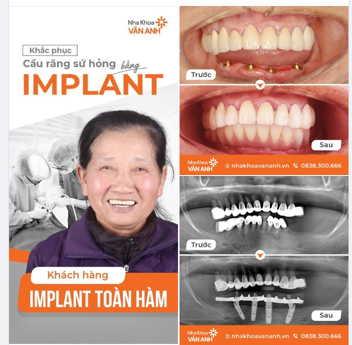 CẤP CỨU CA CẦU RĂNG SỨ HỎNG BẰNG ALL ON 4 - HISAFE