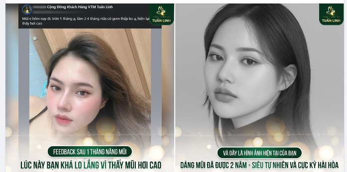 Nâng mũi sau 1 tháng khách sợ hơi cao Tuấn Linh hẹn bạn 6 tháng nếu vẫn cao sẽ hạ thấp cho bạn.