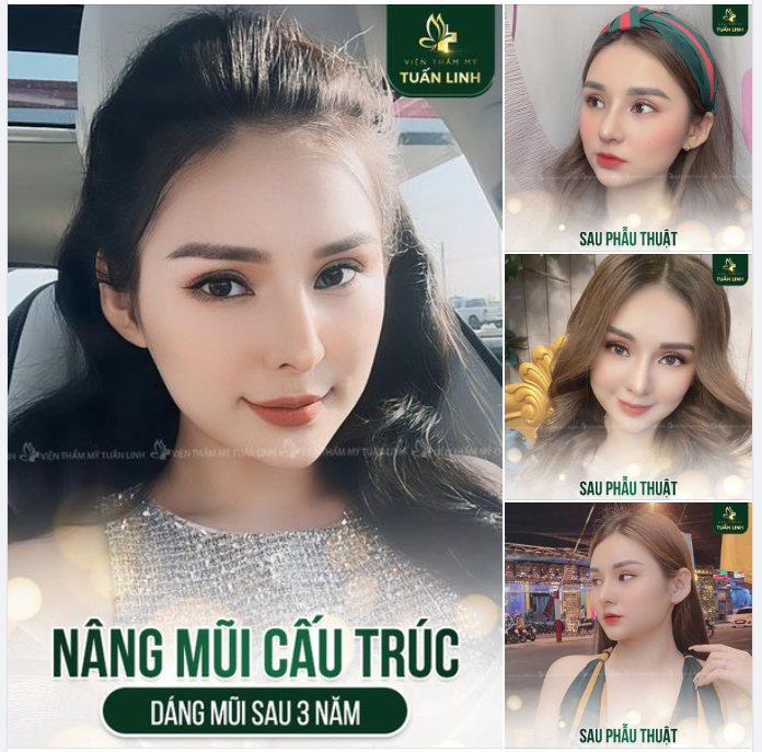 NÂNG MŨI CẤU TRÚC SAU 3 NĂM - QUÁ LÀ XINH ĐẸP KHÁCH ƠI!!