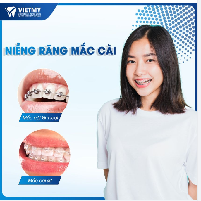 Mắc cài kim loại và mắc cài sứ là 2 loại phổ biến nhất hiện nay, vậy điểm khác biệt giữa 2 mắc cài này là gì ?