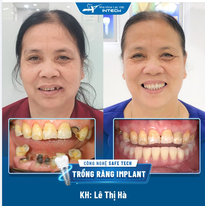 TRỒNG RĂNG IMPLANT TOÀN HÀM DƯỚI - KHÔI PHỤC KHẢ NĂNG ĂN NHAI