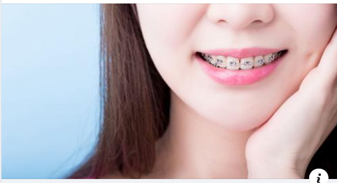 Niềng răng làm thay đổi khuôn mặt