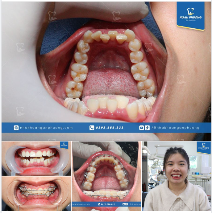 Nhà cửa cây cối gọi là sự vật. Niềng răng đẹp tuyệt vời đó là sự thật