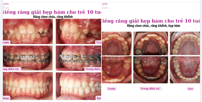 GIẢI HẸP HÀM CHO BÉ 10 TUỔI