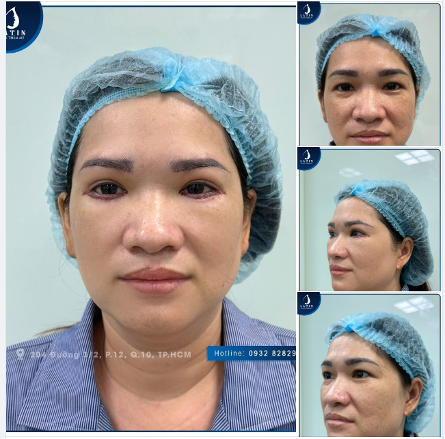 Trẻ hóa mắt với combo nâng cung mày, cắt mí dưới
