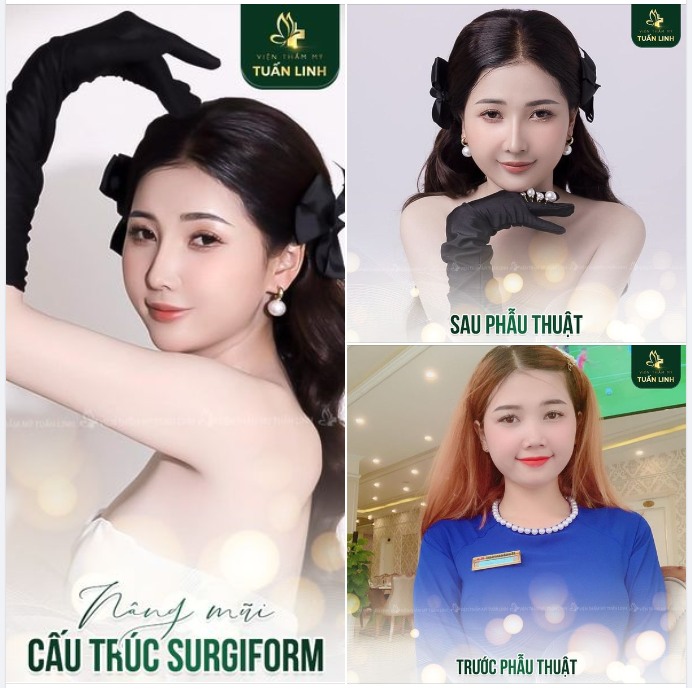 Thích dáng mũi tự nhiên bền đẹp  Chọn ngay nâng mũi cấu trúc Surgiform