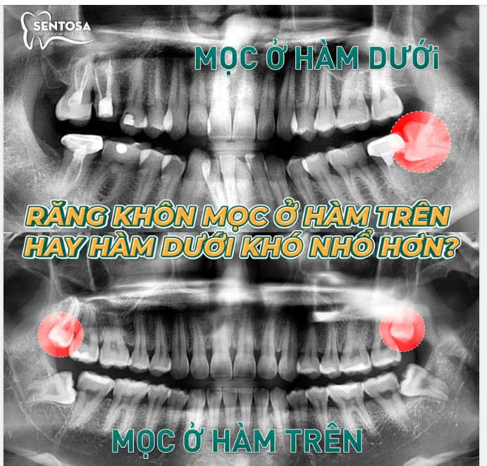 RĂNG KHÔN MỌC Ở HÀM TRÊN HAY HÀM DƯỚI KHÓ NHỔ HƠN?