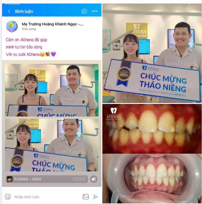 Chúc mừng Trương Hoàng Khánh Ngọc vừa hoàn thành hành trình tháo niềng thành công!