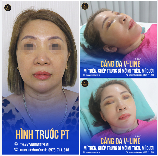 TỚI DR TRÍ là tới đúng địa chỉ để trẻ hóa gương mặt bằng CĂNG DA VLINE và GHÉP TRUNG BÌ MỠ VÙNG MẮT