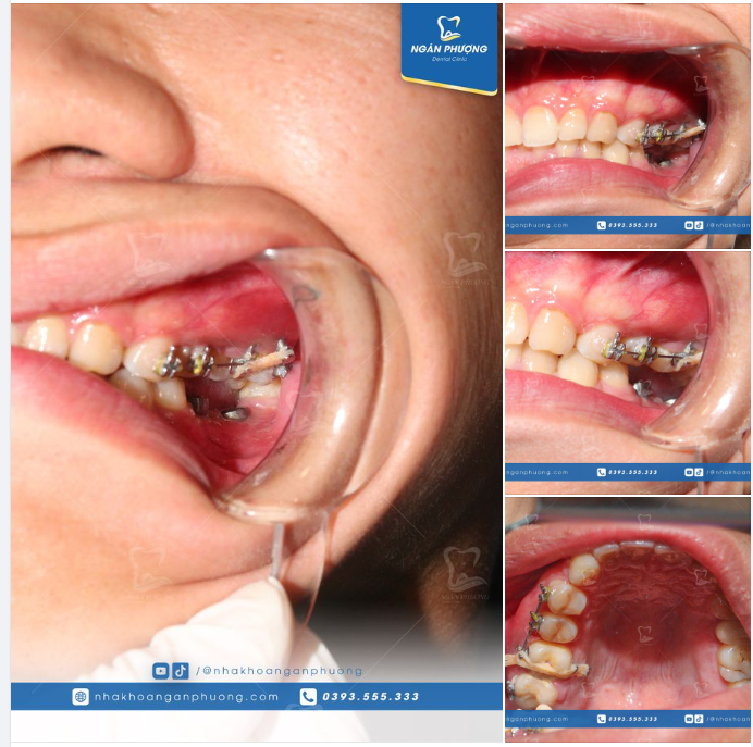 Xương hàm dần tiêu biến. Răng bên cạnh bị xô lệch. Lệch mặt, hóp má,... do không ăn nhai được . Tụt răng hàm trên nếu bị mất răng hàm dưới