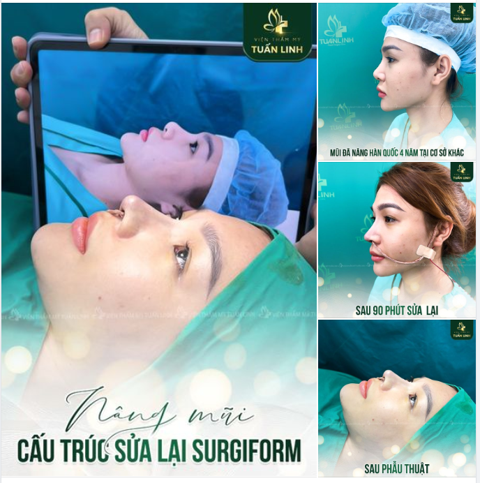 Nâng mũi cấu trúc sửa lại Surgiform. Mong muốn dáng mũi tự nhiên, đầu mũi bay