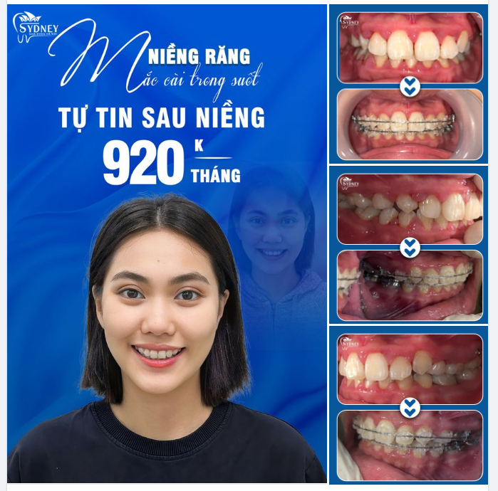 HÀ NỘI NIỀNG RĂNG Ở ĐÂU UY TÍN?
