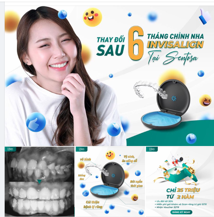 THAY ĐỔI SAU 6 THÁNG CHỈNH NHA INVISALIGN TẠI SENTOSA