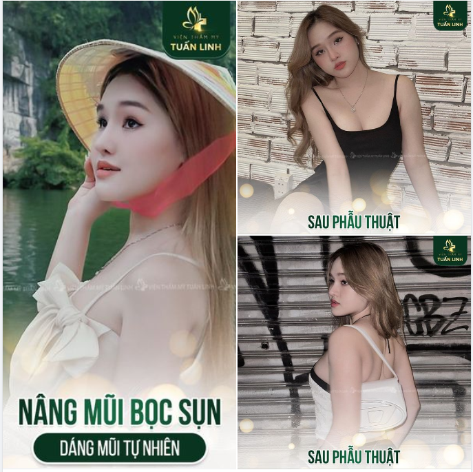 Nâng mũi bọc sụn tại Tuấn Linh chưa bao giờ hết HOT!!