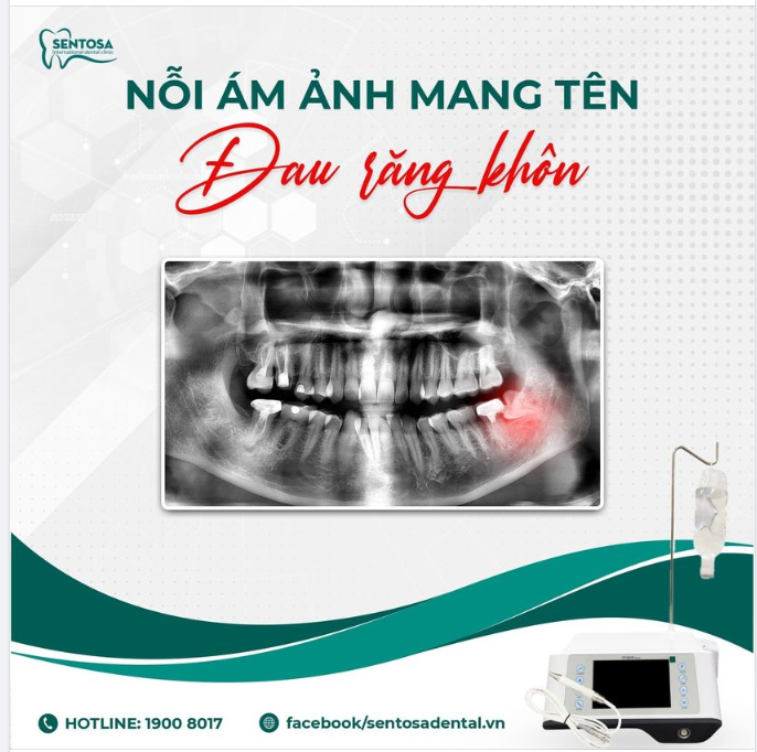 "NỖI ÁM ẢNH MANG TÊN ĐAU RĂNG KHÔN"