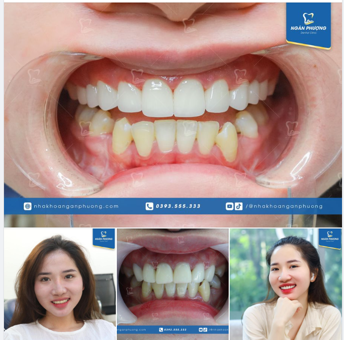 Chẳng cần hào nhoáng mỹ miều. Răng xinh cười đẹp yêu kiều tự tin