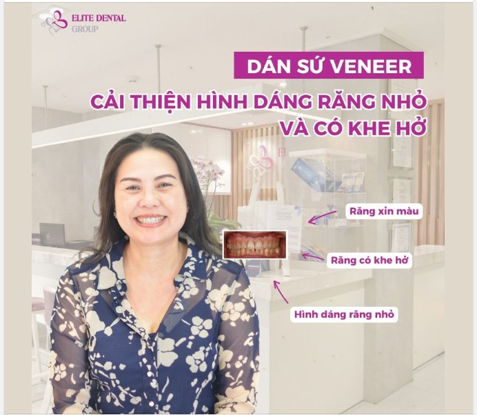 Dán sứ Veneer: Cải thiện hình dáng nhỏ và có khe hở giữa các răng hàm dưới