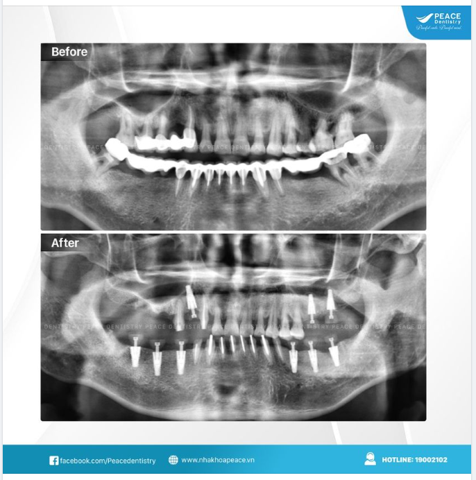 THAY CẦU RĂNG SỨ CŨ BẰNG  CẤY GHÉP IMPLANT