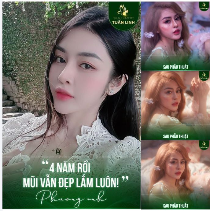 Khách hàng P.A đã nâng mũi tại Tuấn Linh được 4 năm rồi. Dáng mũi hiện tại của bạn vẫn rất đẹp và cực kỳ ổn định.