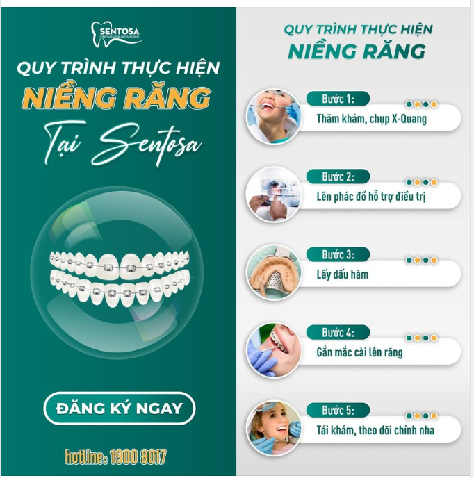 TÌM HIỂU QUY TRÌNH NIỀNG RĂNG TẠI NHA KHOA SENTOSA