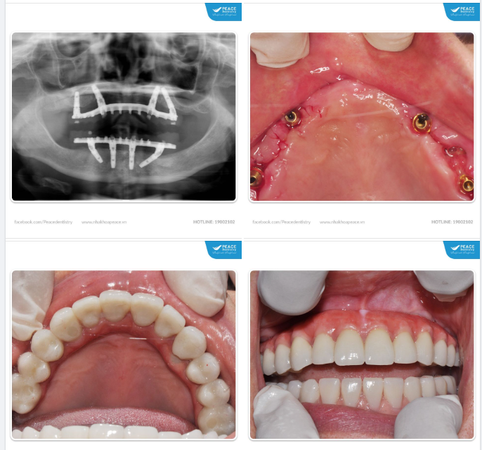 CẤY GHÉP IMPLANT - THÀNH TỰU CỦA NHA KHOA HIỆN ĐẠI