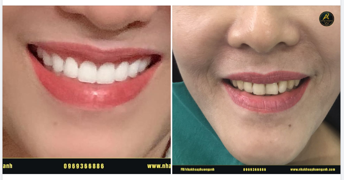 Răng Cửa To Có Làm Nhỏ Lại Được Không?
