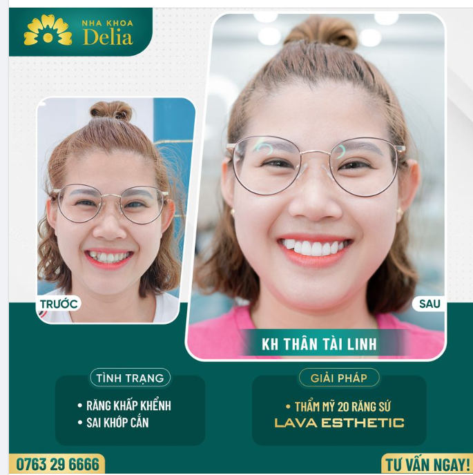 Những thay đổi của chị Linh sau khi sở hữu nụ cười mới rạng rỡ tại nha khoa Delia nhé!
