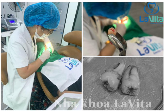 CHƯA KỊP ĐAU ĐÃ NHỔ XONG RĂNG KHÔN LÀ CÂU CHUYỆN HOÀN TOÀN CÓ THẬT