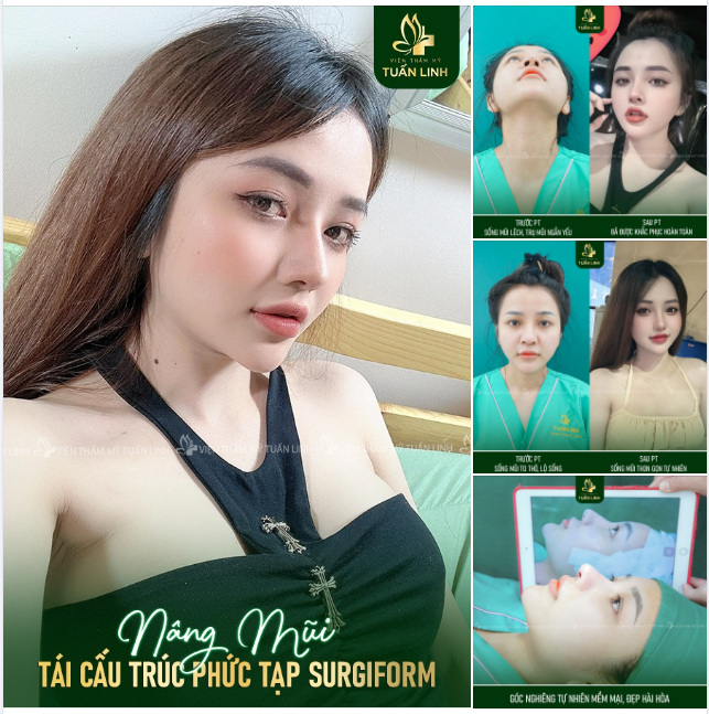 Nỗi ám ảnh mang tên "nâng mũi hỏng, mũi không đẹp phải sửa lại"!!