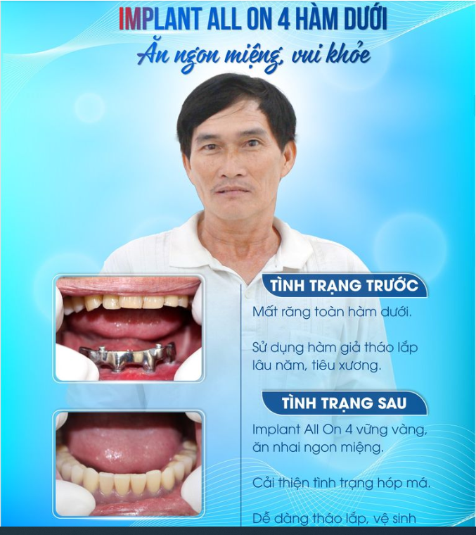 CASE THỰC TẾ - IMPLANT ALL ON 4 HÀM DƯỚI ĂN NGON MIỆNG, VUI KHỎE