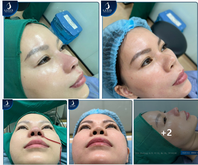 Tìm lại tự tin cho chị gái đã từng nâng mũi ở nơi khác không thành công