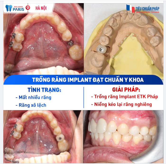 Trồng răng ngay nếu bạn không muốn mất hết cả hàm răng Khách hàng dưới đây bị mất răng hàm nhưng chủ quan không trồng lại. Do đó dẫn đến tình trạng các răng còn lại ngả nghiêng và bắt đầu xuất hiện tình trạng tiêu xương. Tình trạng này nếu kéo dài sẽ