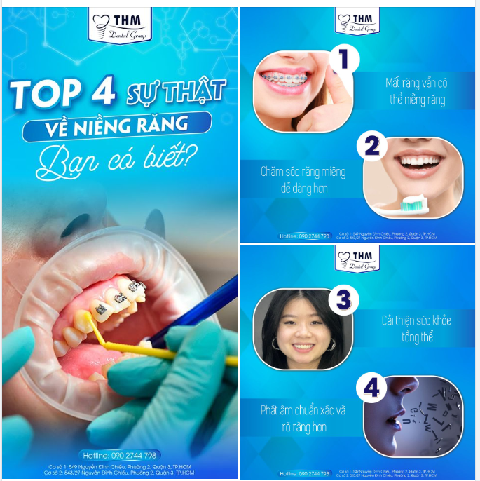TOP 4 SỰ THẬT VỀ NIỀNG RĂNG BẠN CÓ BIẾT?