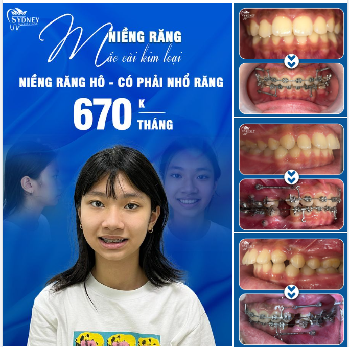 NIỀNG RĂNG HÔ CÓ PHẢI NHỔ RĂNG KHÔNG?