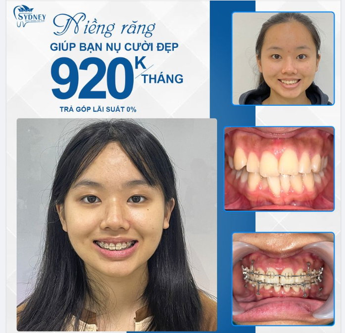HÀ NỘI GIỜ ĐÃ SANG THU  TIỆN CHO NHA KHOA HỎI BẠN ĐÃ CÓ NỤ CƯỜI XINH ĐÓN CHÀO MÙA THU CHƯA?