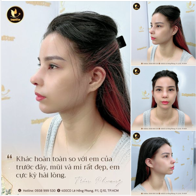 “Khác hoàn toàn so với em của trước đây, mũi và mí rất đẹp, em cực kỳ hài lòng” – Bạn Trần Phượng chia sẻ.