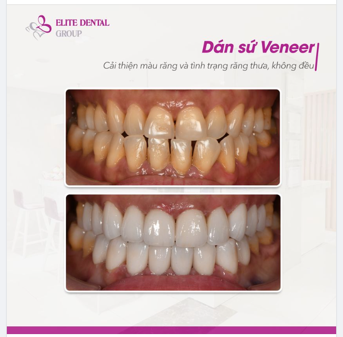 Cải thiện màu răng và tình trạng răng không đều nhờ dán sứ Veneer