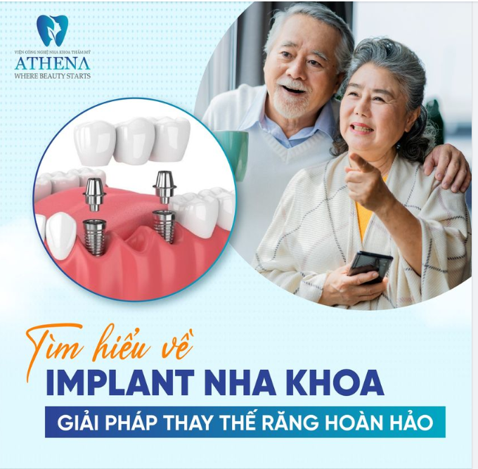 Implant - Giải pháp thay thế răng hoàn hảo