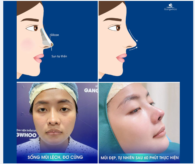 NÂNG MŨI - VÌ SAO NÊN CHỌN NÂNG MŨI CÓ SỤN TỰ THÂN?