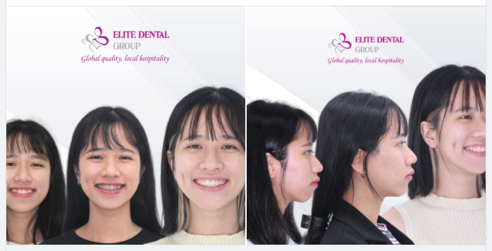 “QUÁ BẤT NGỜ VÌ CHƯA QUEN NHÌN RĂNG ĐỀU THẲNG TẤP NHƯ VẬY, MÌNH CẢM THẤY ĐƯỜNG NÉT TRÊN GƯƠNG MẶT THÙY MỊ HƠN RẤT NHIỀU”