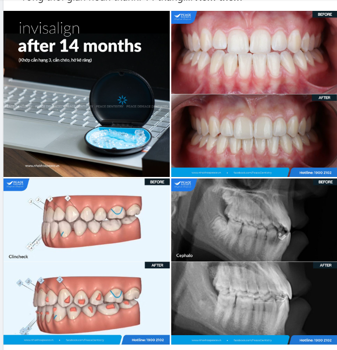 Trước và sau 14 tháng với ca chỉnh nha Invisalign cho khách hàng 14 tuổi