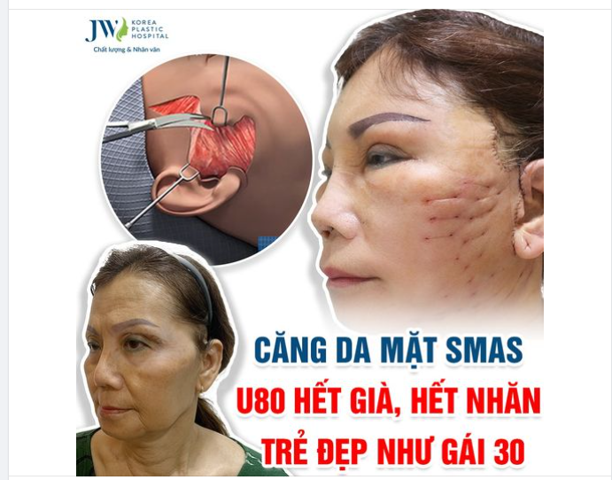 CĂNG DA MẶT SMAS - TRẺ NGAY 10 TUỔI TỨC THÌ
