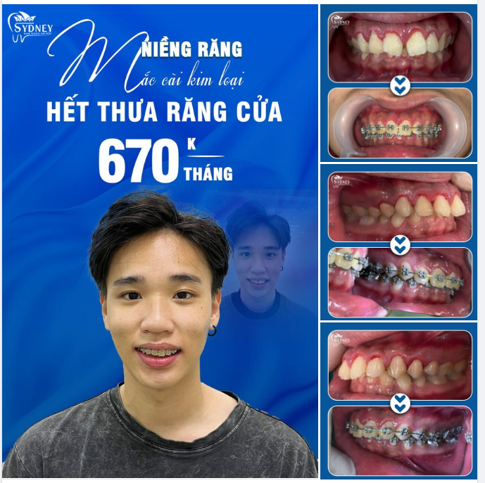 CÓ PHẢI BẠN ĐANG TỰ TI VỀ RĂNG CỬA THƯA?