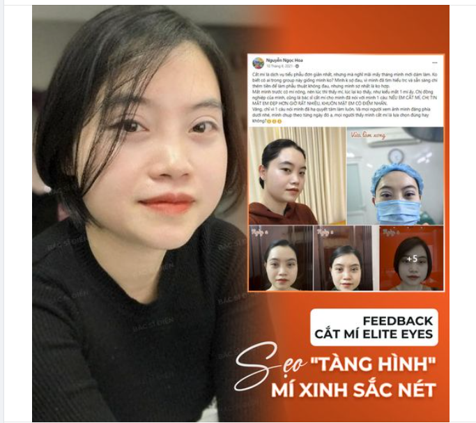 SẸO "TÀNG HÌNH" - MÍ XINH SẮC NÉT